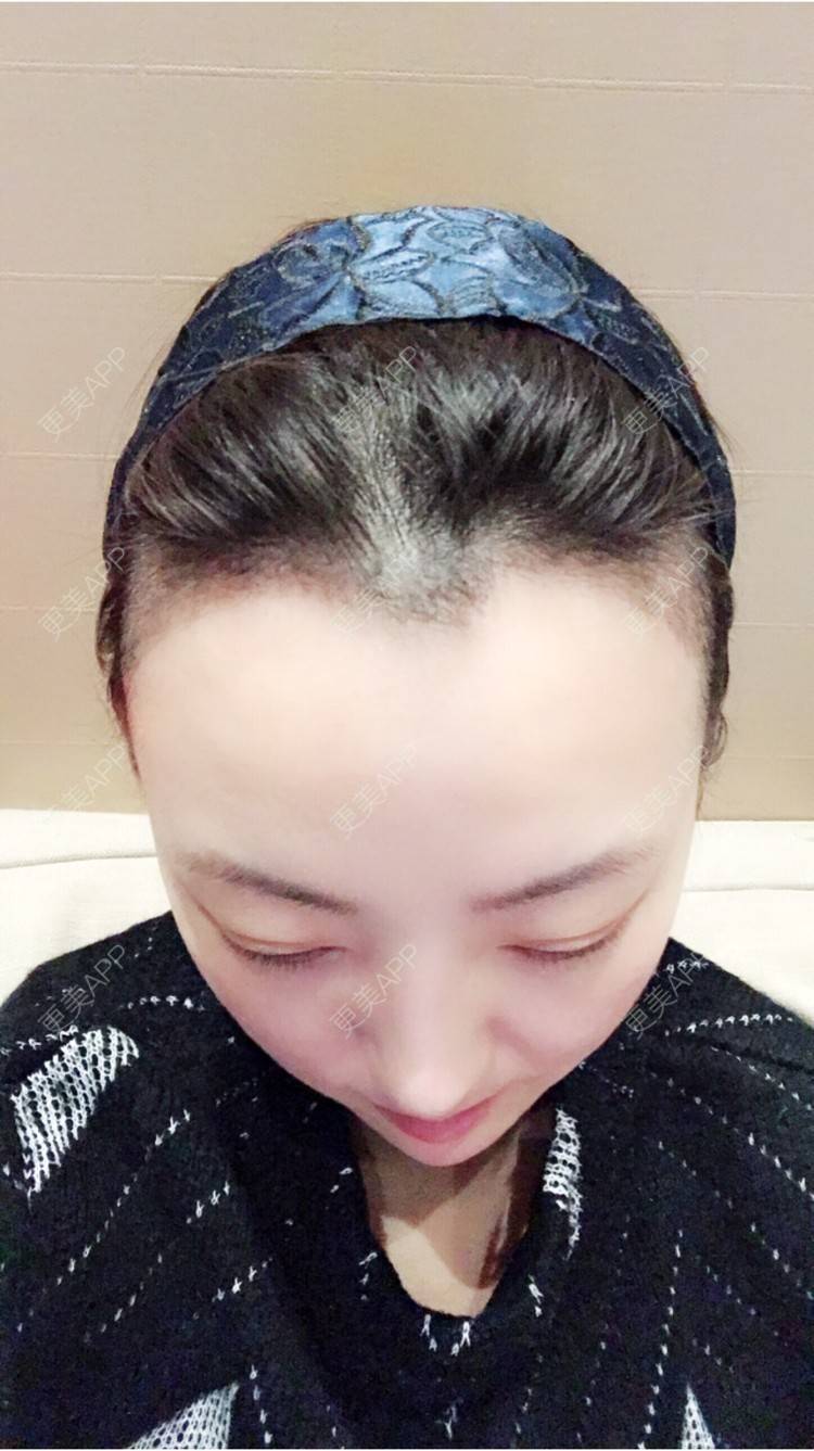 久爱必疯的植发际线日记