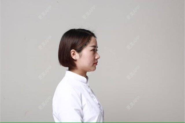 更美 - 李鑫 医生的玻尿酸下巴经验 | 玻尿酸下巴