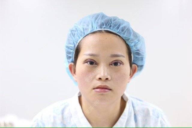 更美 - 段天香 医生的全切双眼皮经验 | 全切双眼皮 | 苏州