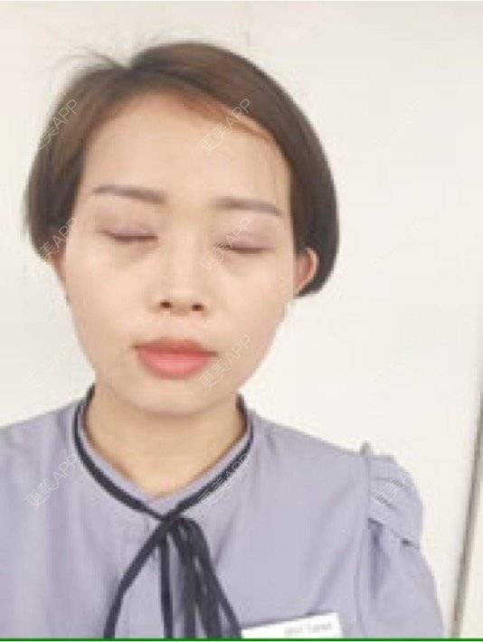 更美 - 段天香 医生的全切双眼皮经验 | 全切双眼皮 | 苏州