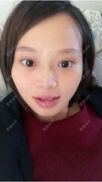 更美 - 段天香 医生的全切双眼皮经验 | 全切双眼皮 | 苏州