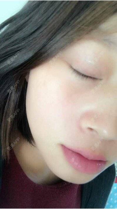 更美 - 段天香 医生的全切双眼皮经验 | 全切双眼皮 | 苏州