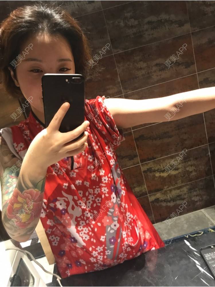更美 - Joni小小板娘的射频溶脂瘦手臂经验 | 上海 | 视频日记 | 射频溶脂瘦手臂