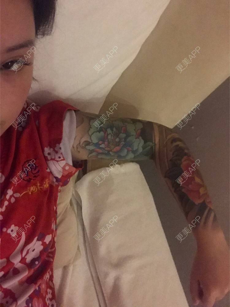 更美 - Joni小小板娘的射频溶脂瘦手臂经验 | 上海 | 视频日记 | 射频溶脂瘦手臂
