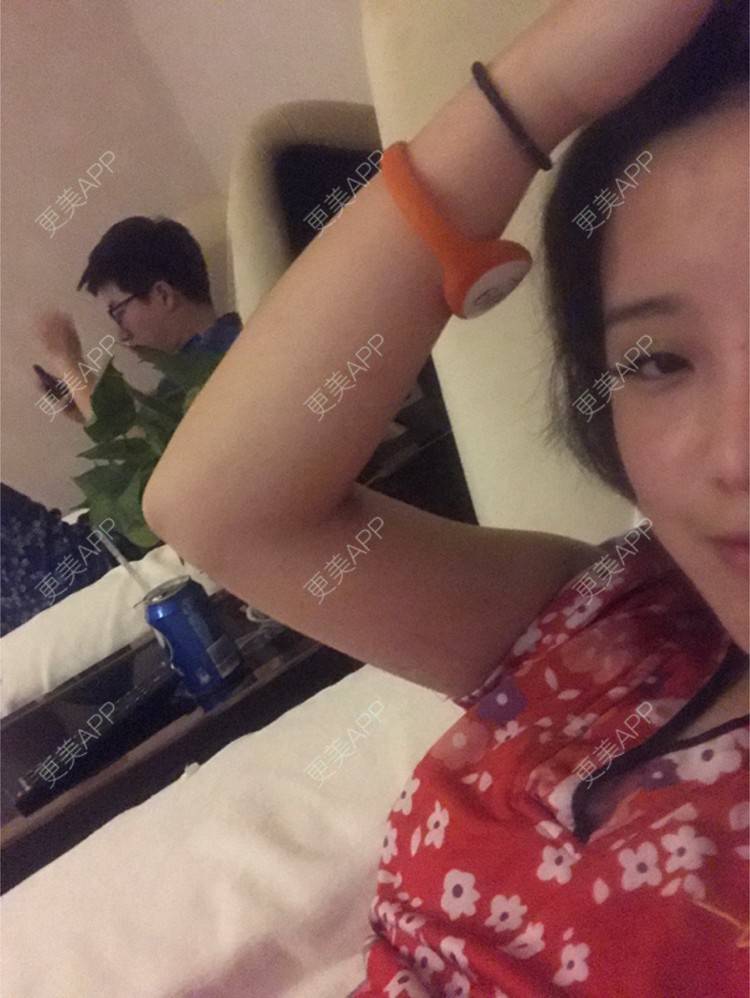 更美 - Joni小小板娘的射频溶脂瘦手臂经验 | 上海 | 视频日记 | 射频溶脂瘦手臂