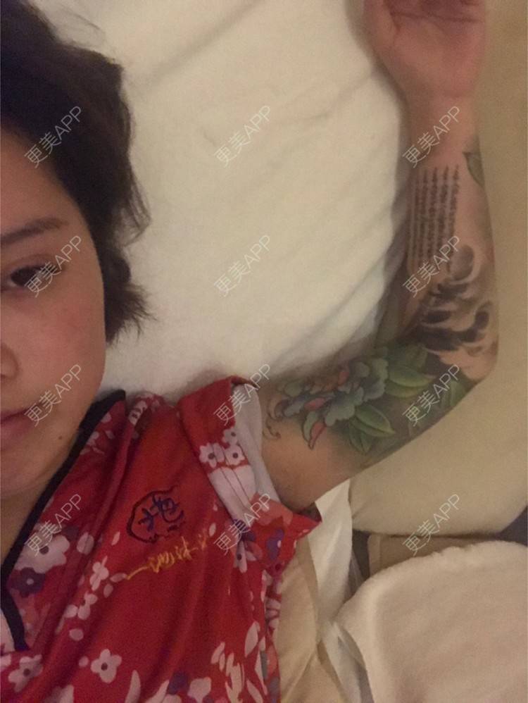 更美 - Joni小小板娘的射频溶脂瘦手臂经验 | 上海 | 视频日记 | 射频溶脂瘦手臂