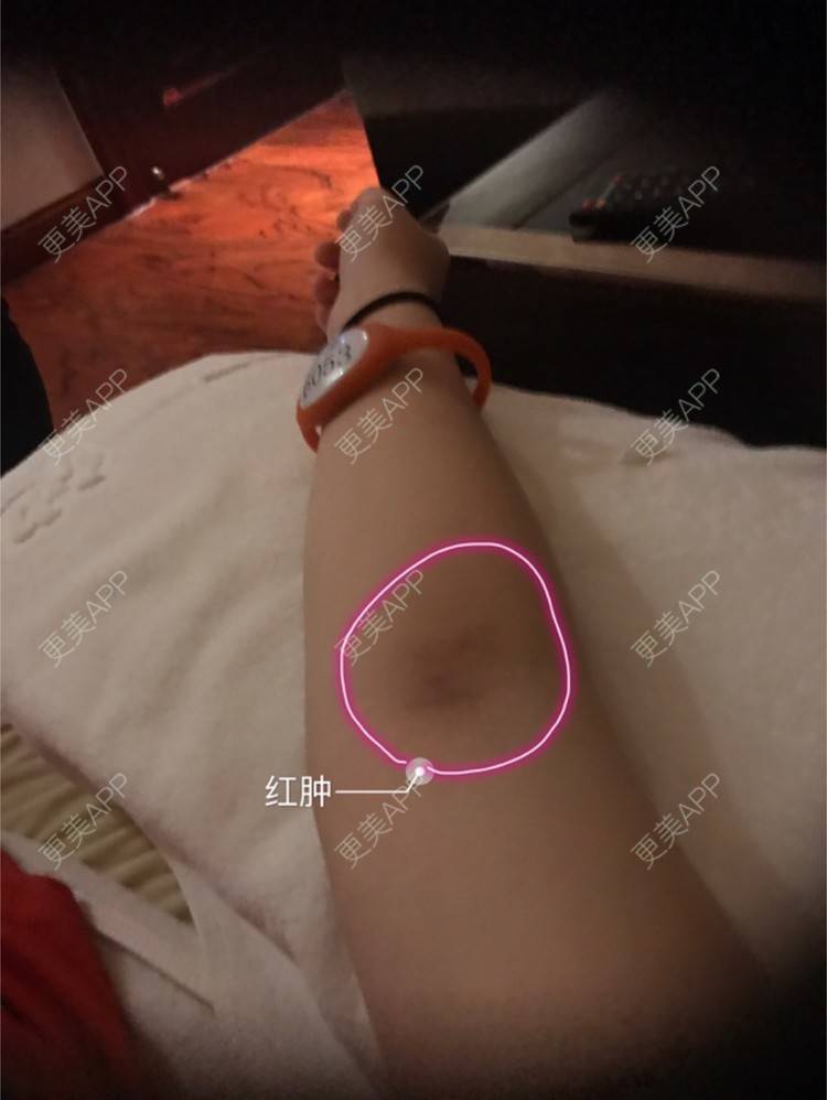 更美 - Joni小小板娘的射频溶脂瘦手臂经验 | 上海 | 视频日记 | 射频溶脂瘦手臂