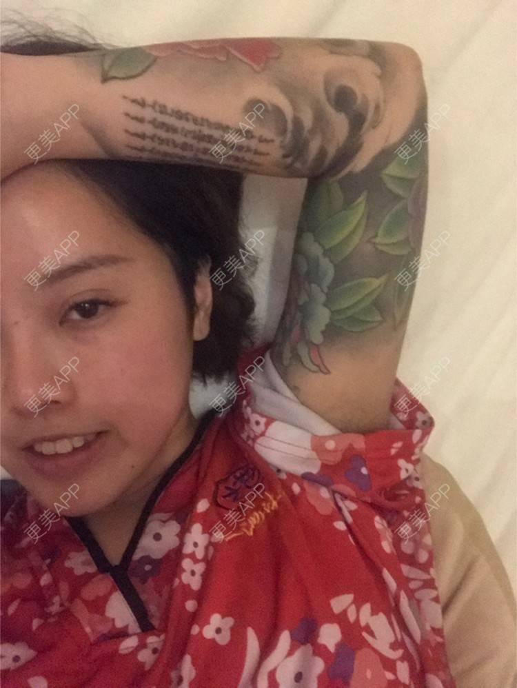 更美 - Joni小小板娘的射频溶脂瘦手臂经验 | 上海 | 视频日记 | 射频溶脂瘦手臂