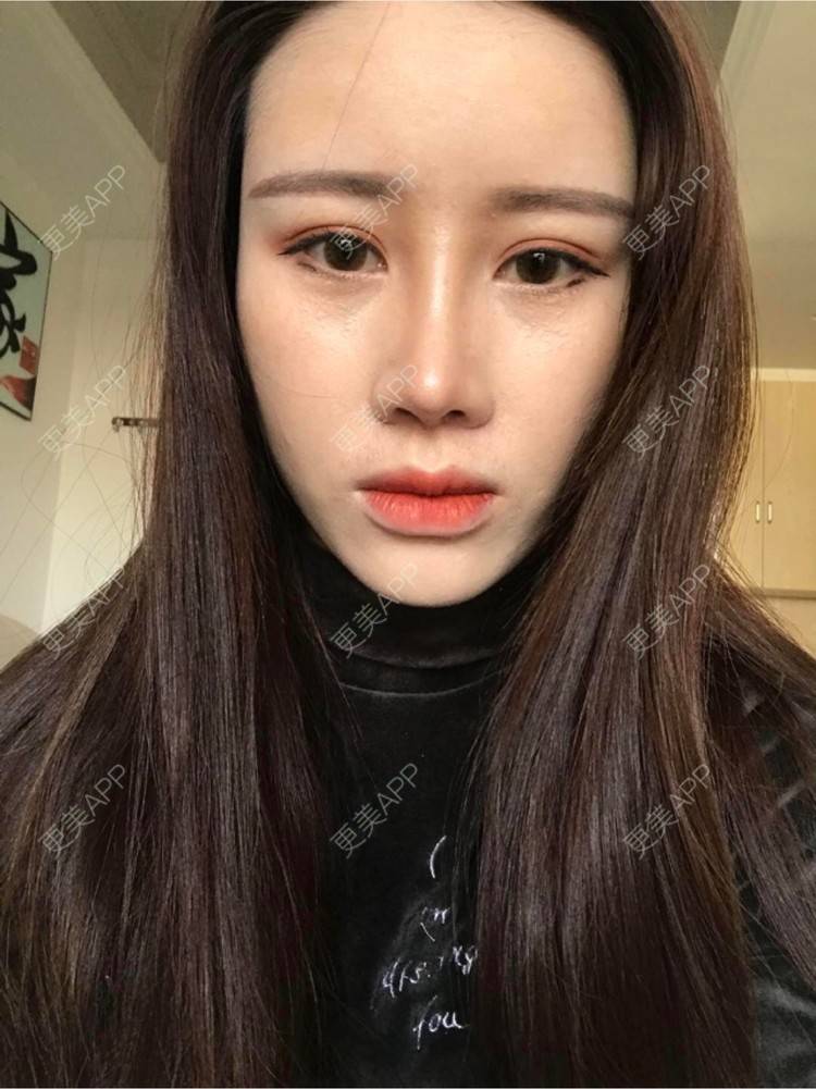 更美 - 温故而知欣的鼻部多项经验 | 视频日记 | 自体软骨隆鼻 | 武汉 | 鼻部多项 | 鼻部整形