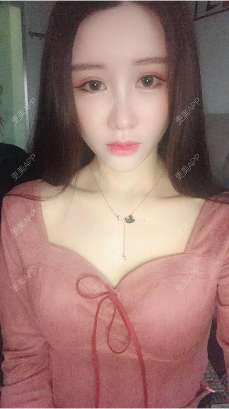 更美 - 温故而知欣的鼻部多项经验 | 视频日记 | 自体软骨隆鼻 | 武汉 | 鼻部多项 | 鼻部整形