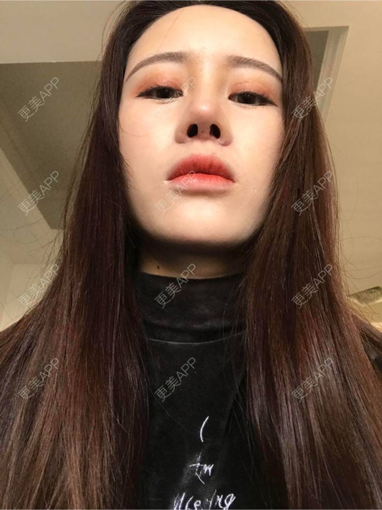 更美 - 温故而知欣的鼻部多项经验 | 视频日记 | 自体软骨隆鼻 | 武汉 | 鼻部多项 | 鼻部整形