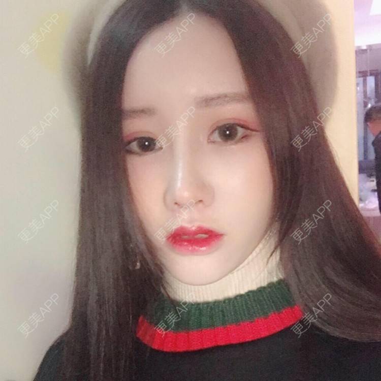 更美 - 温故而知欣的鼻部多项经验 | 视频日记 | 自体软骨隆鼻 | 武汉 | 鼻部多项 | 鼻部整形