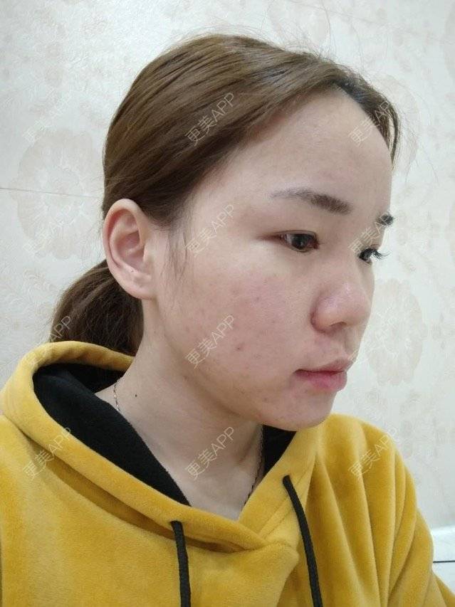 更美 - 苹果仔🌈的果酸焕肤经验 | 宣城 | 消炎祛痘 | 果酸焕肤 | 皮肤美容