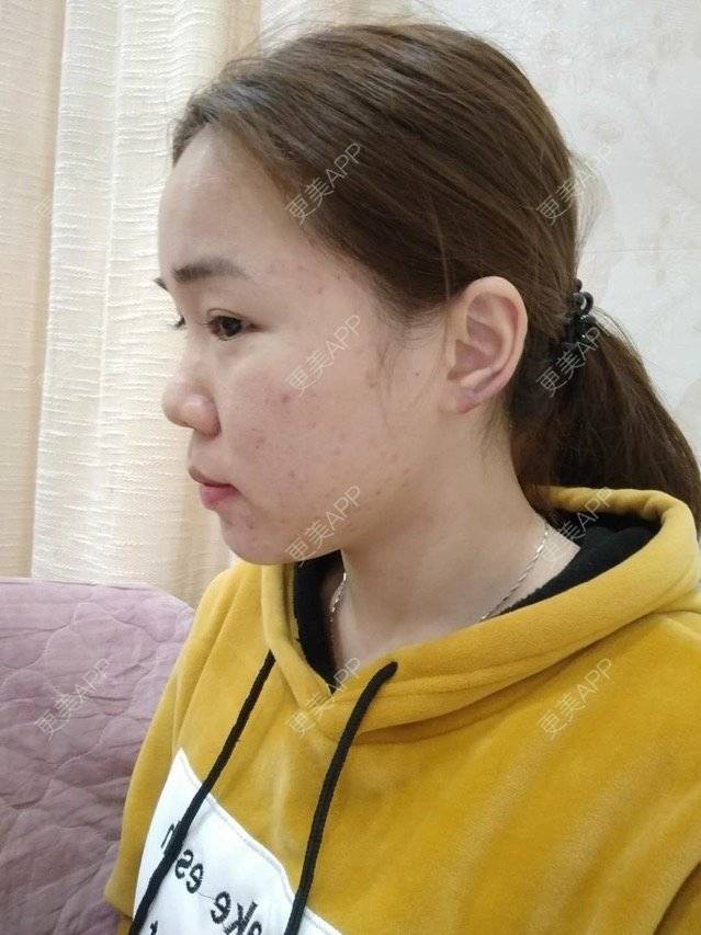 更美 - 苹果仔🌈的果酸焕肤经验 | 宣城 | 消炎祛痘 | 果酸焕肤 | 皮肤美容