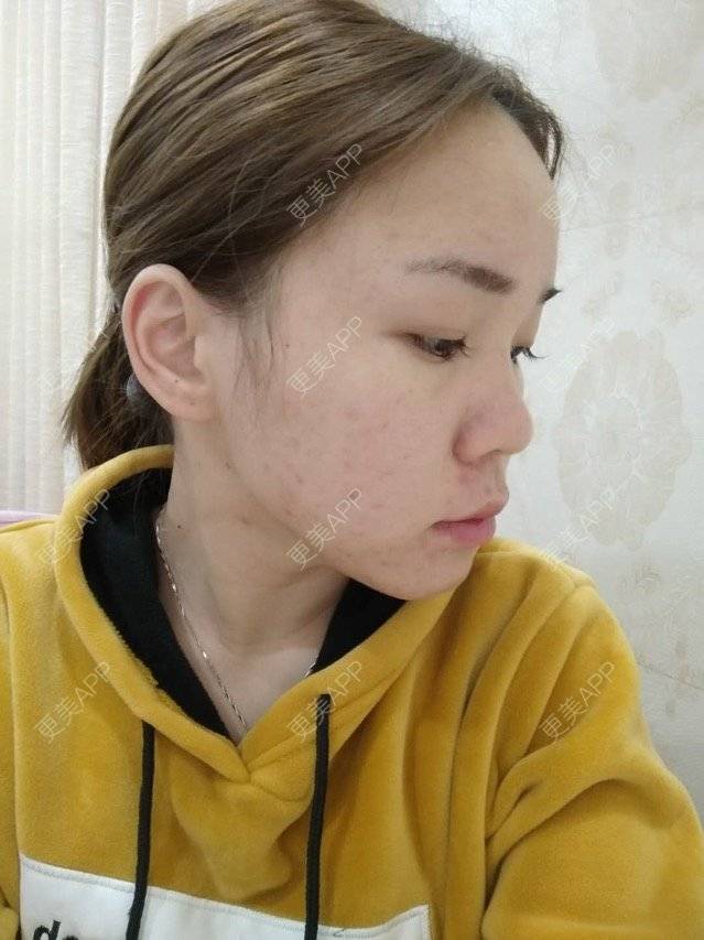 更美 - 苹果仔🌈的果酸焕肤经验 | 宣城 | 消炎祛痘 | 果酸焕肤 | 皮肤美容