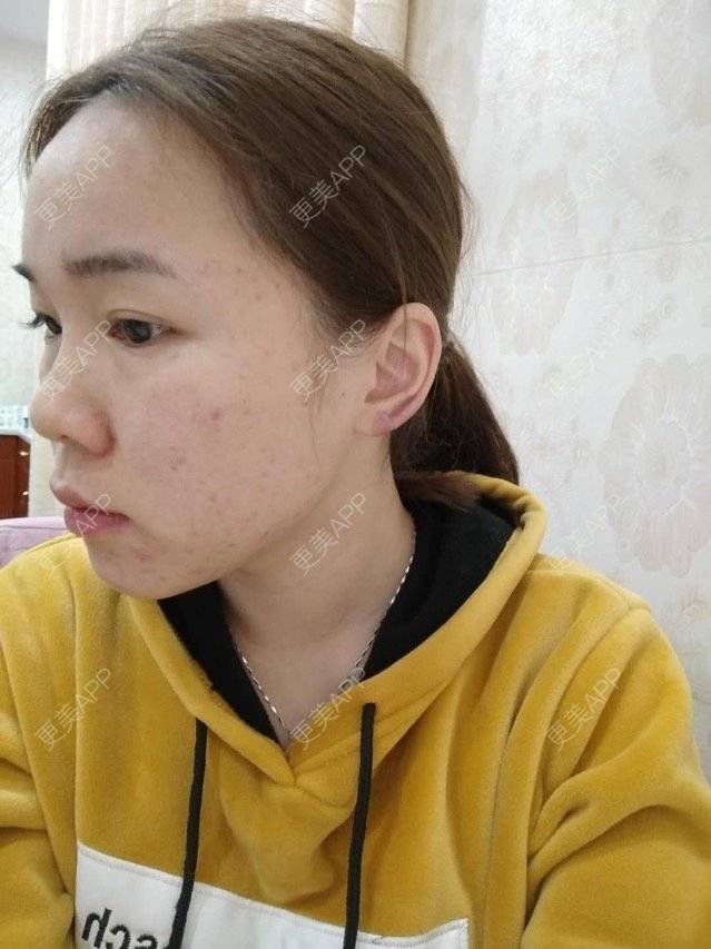 更美 - 苹果仔🌈的果酸焕肤经验 | 宣城 | 消炎祛痘 | 果酸焕肤 | 皮肤美容