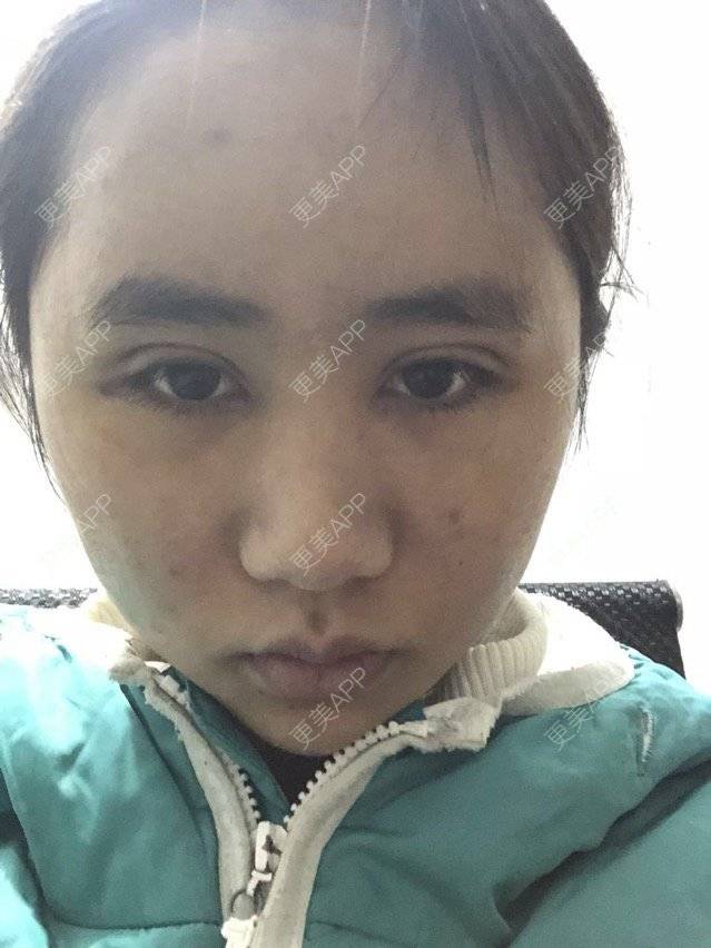 更美 - 苏州工业园区颜术医疗美容诊所的全切双眼皮经验 | 芜湖 | 全切双眼皮