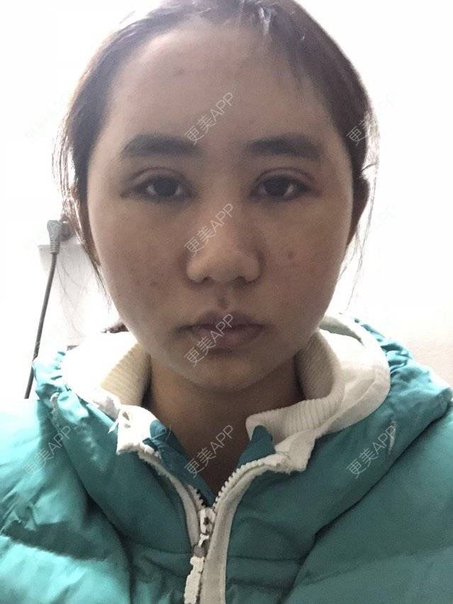 更美 - 苏州工业园区颜术医疗美容诊所的全切双眼皮经验 | 芜湖 | 全切双眼皮