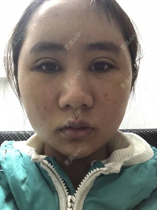 更美 - 苏州工业园区颜术医疗美容诊所的全切双眼皮经验 | 芜湖 | 全切双眼皮