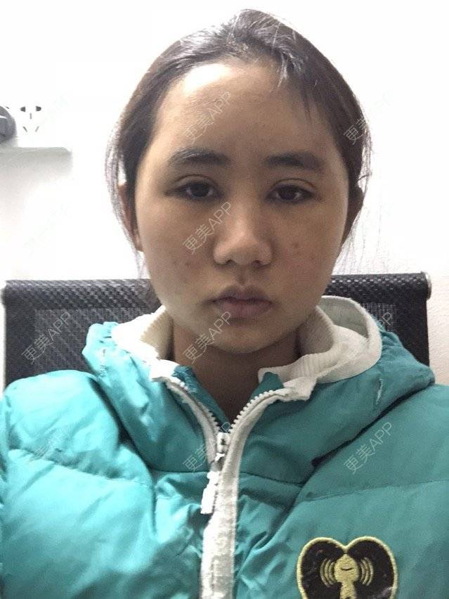更美 - 苏州工业园区颜术医疗美容诊所的全切双眼皮经验 | 芜湖 | 全切双眼皮