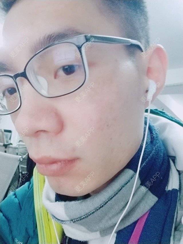 更美 - 更美用户PdQrraCkOQ的红蓝光清痘经验 | 红蓝光清痘 | 广州 | 消炎祛痘 | 皮肤美容