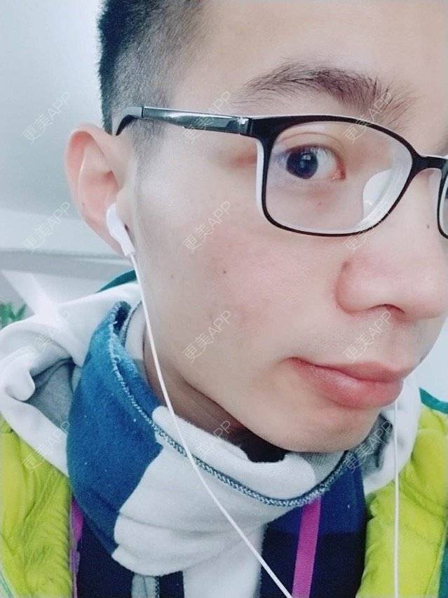 更美 - 更美用户PdQrraCkOQ的红蓝光清痘经验 | 红蓝光清痘 | 广州 | 消炎祛痘 | 皮肤美容