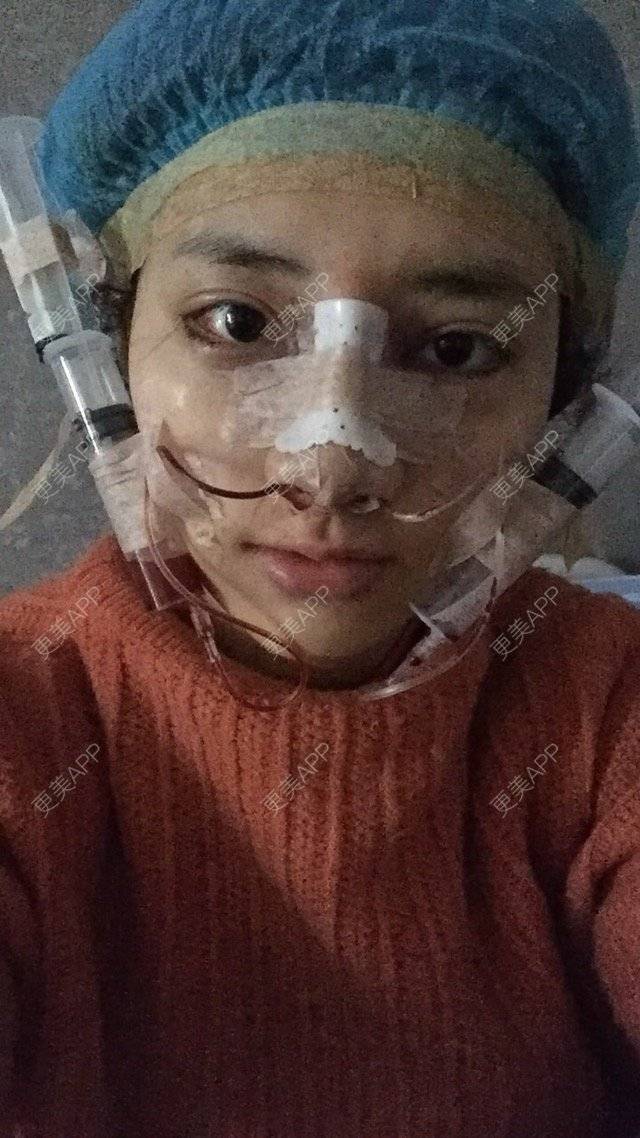 更美 - 黄金金的开外眼角经验 | 开外眼角 | 鼻骨内推 | 潮州 | 眼角下至