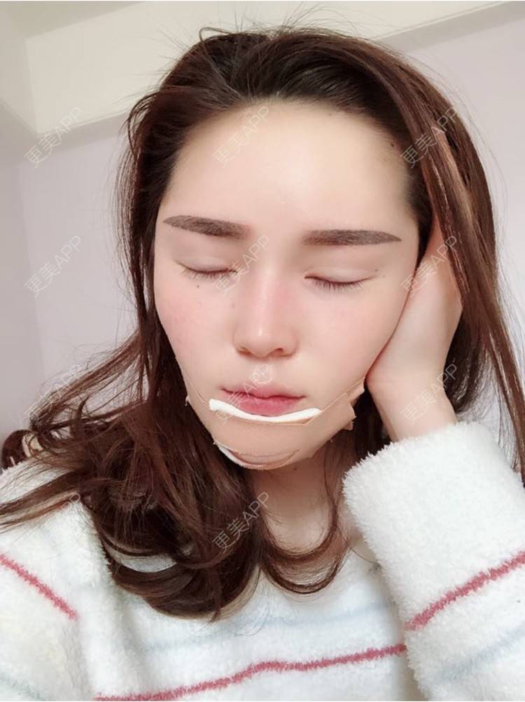 硅胶垫下巴前后对比照_起风了啊硅胶垫下巴前后对比照_术后1天__更美