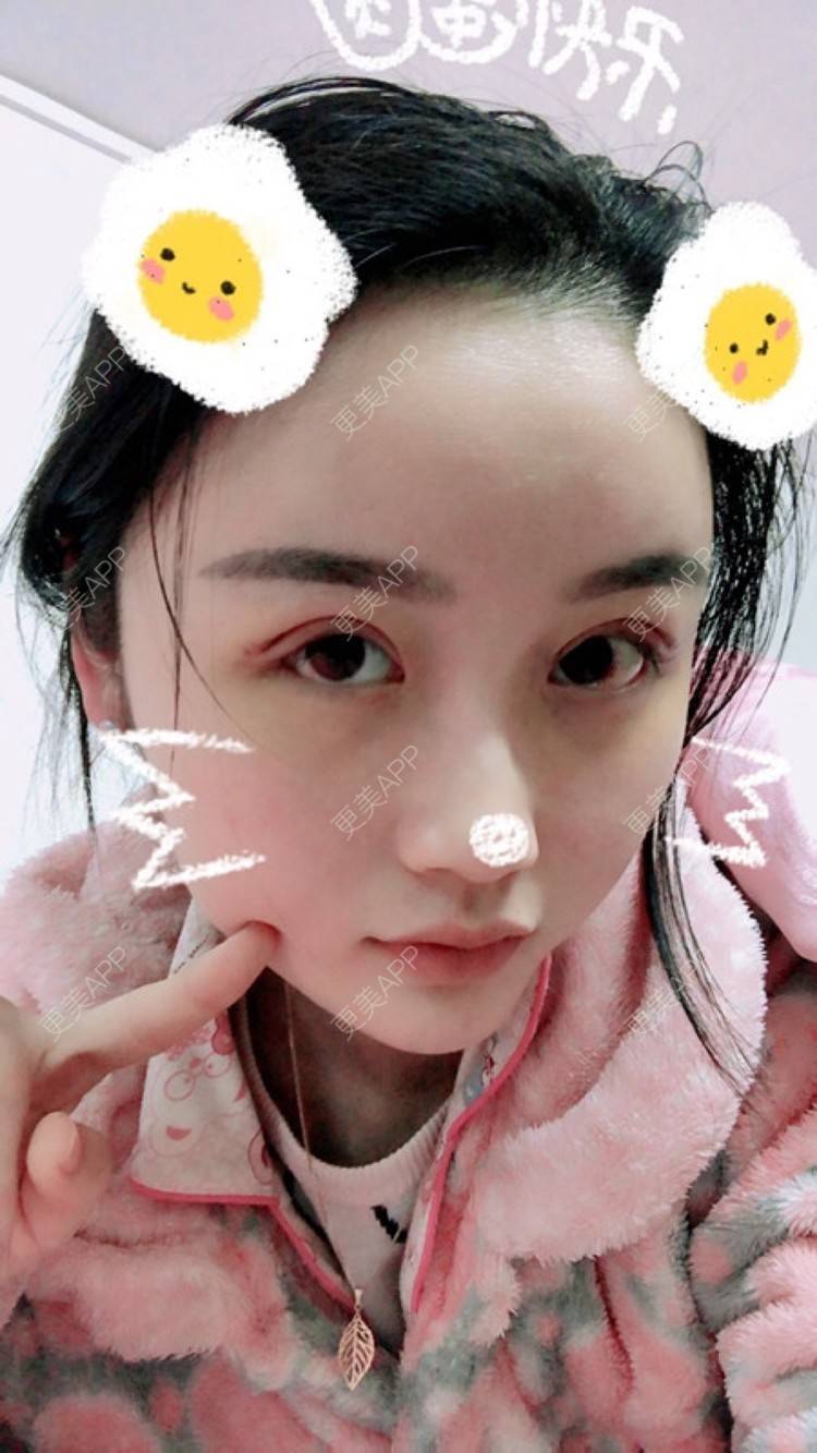 更美 - 琅琊榜小粉丝的全切双眼皮日记 | 眼综合 | 眼部综合 | 武汉