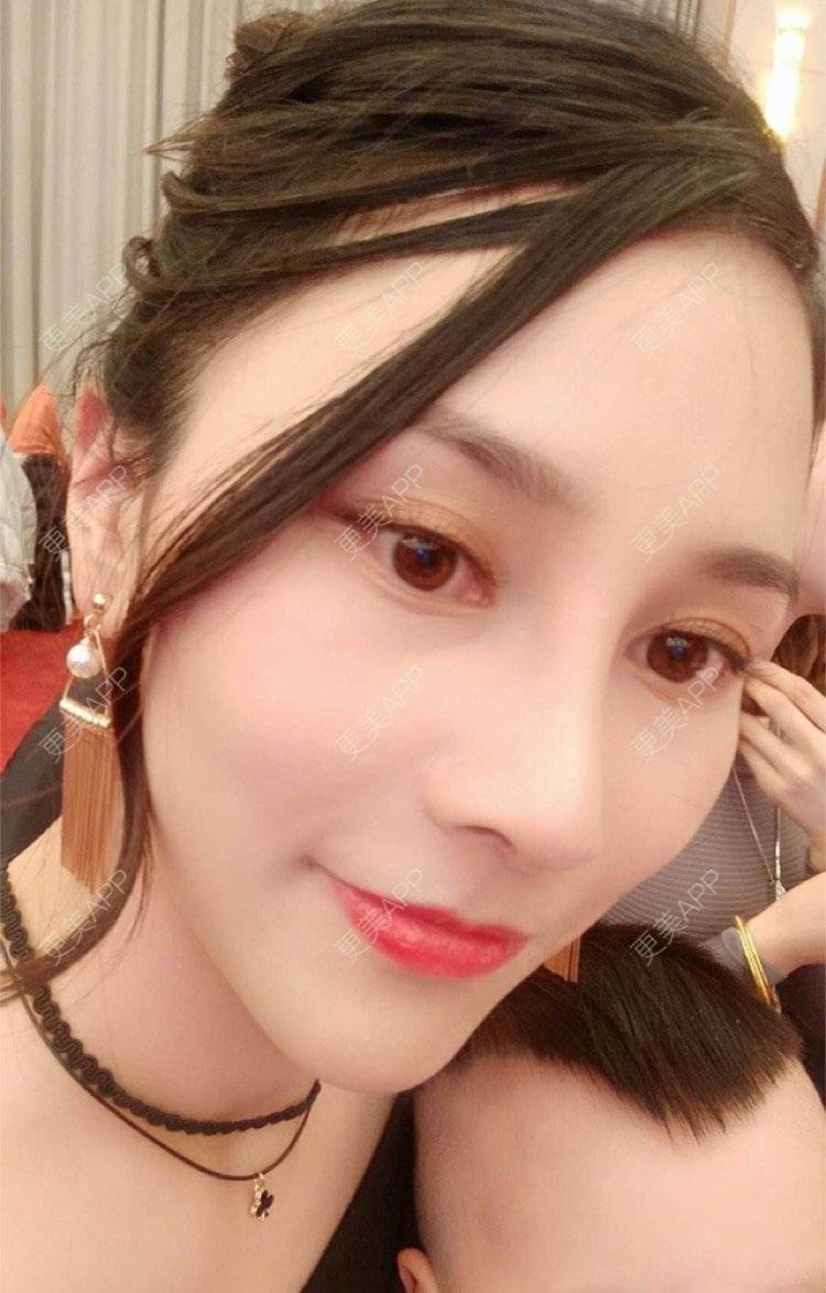 天线宝宝589的鼻综合日记