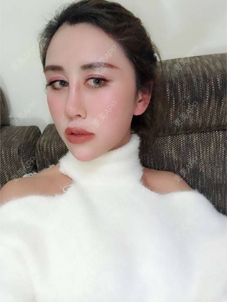 注射美容 | 视频日记 | 鼻综合 | 广州 | 鼻部整形