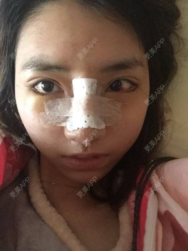 更美 - 黄金金的开外眼角经验 | 开外眼角 | 潮州 | 鼻骨内推 | 下至
