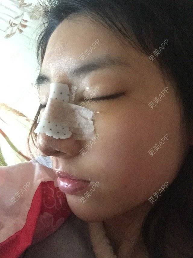更美 - 黄金金的开外眼角经验 | 开外眼角 | 潮州 | 鼻骨内推 | 下至
