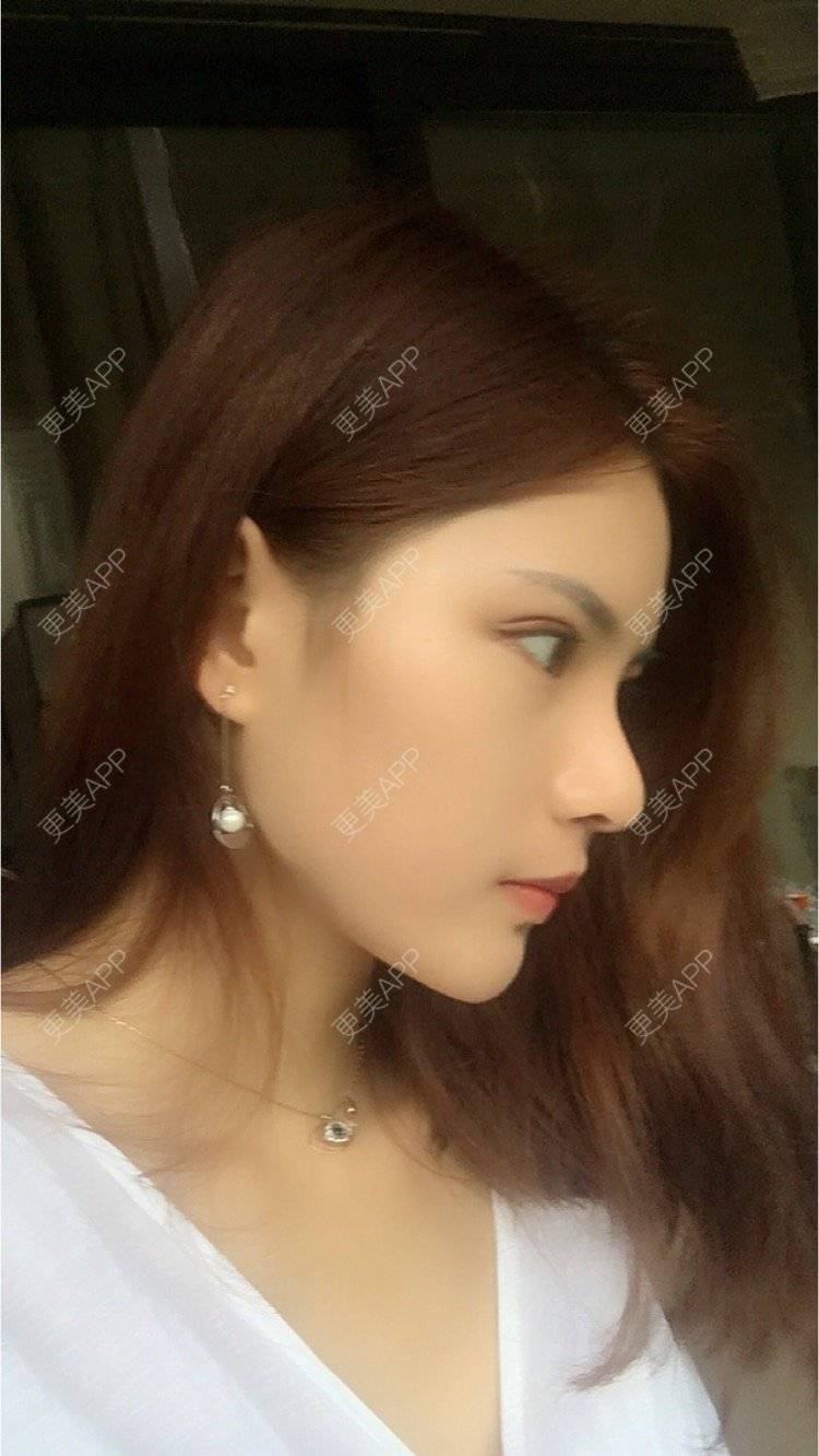 自体软骨垫鼻尖前后对比照_我不是虞姬_术后151天__更美