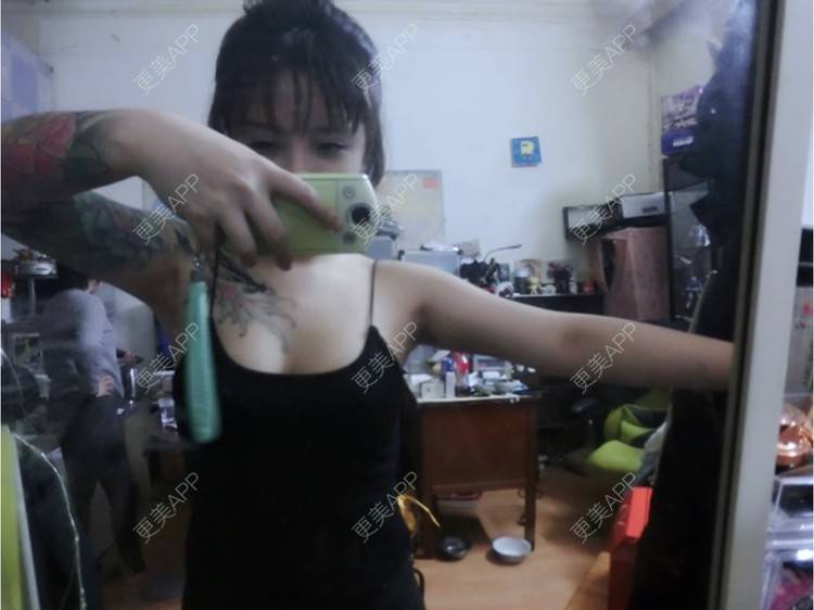 更美 - Joni小小板娘的射频溶脂瘦手臂经验 | 上海 | 视频日记 | 射频溶脂瘦手臂