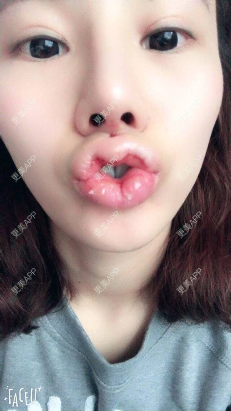 爱情总还是有的的m唇成形术日记