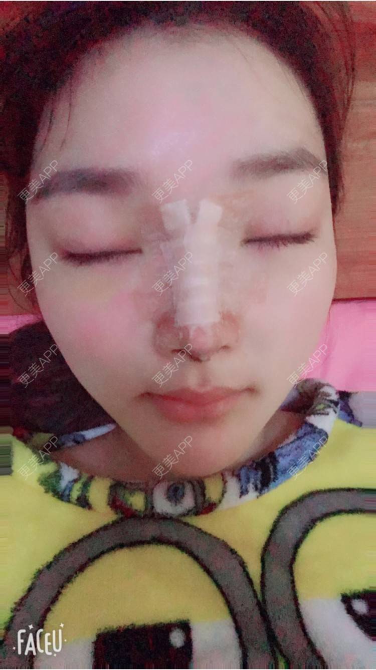 更美 - 雪儿妹子的肋软骨隆鼻经验 | 鼻部整形 | 肋软骨隆鼻 | 隆鼻失败修复 | 重庆