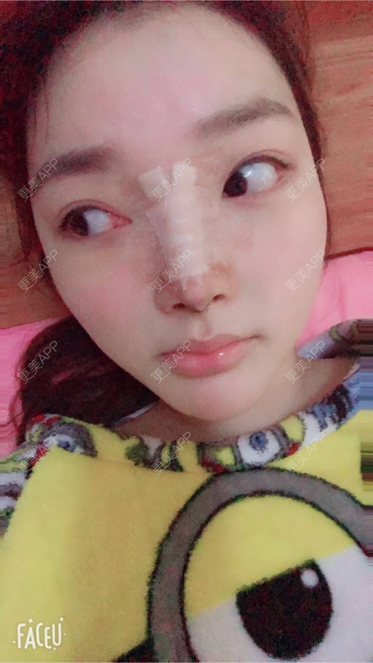 更美 - 雪儿妹子的肋软骨隆鼻经验 | 鼻部整形 | 肋软骨隆鼻 | 隆鼻失败修复 | 重庆