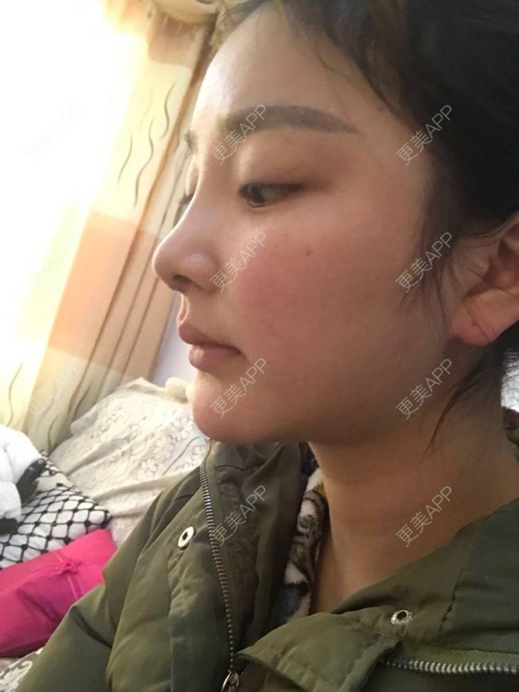 更美 - 雪儿妹子的肋软骨隆鼻经验 | 鼻部整形 | 肋软骨隆鼻 | 隆鼻失败修复 | 重庆