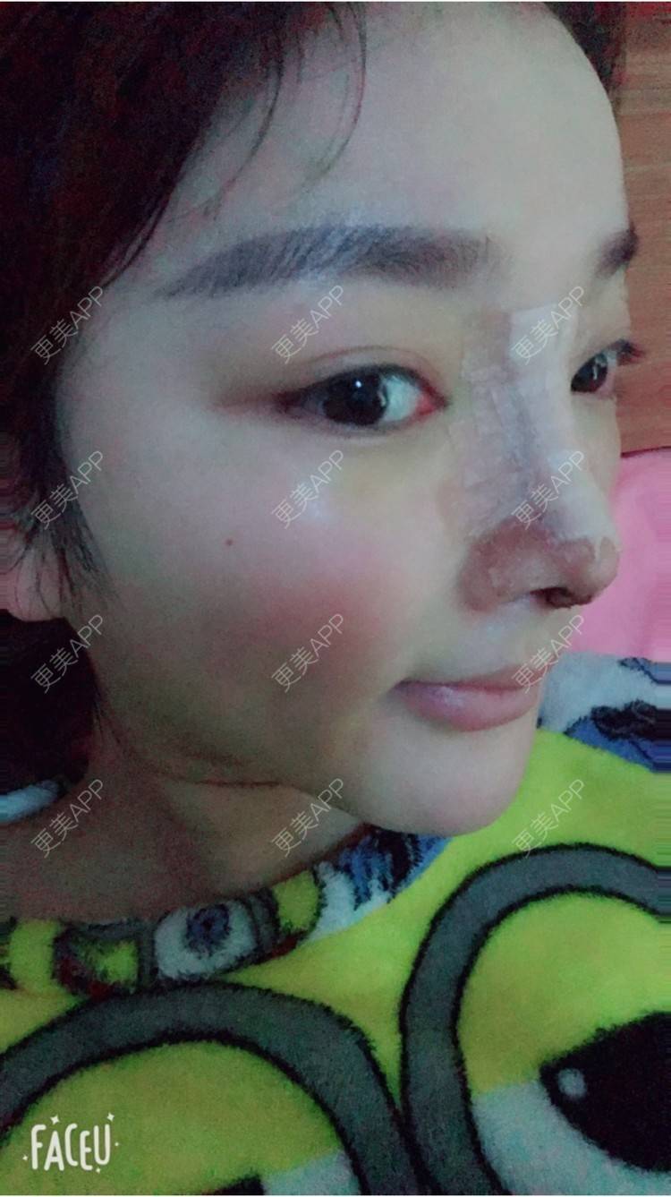 更美 - 雪儿妹子的肋软骨隆鼻经验 | 鼻部整形 | 肋软骨隆鼻 | 隆鼻失败修复 | 重庆