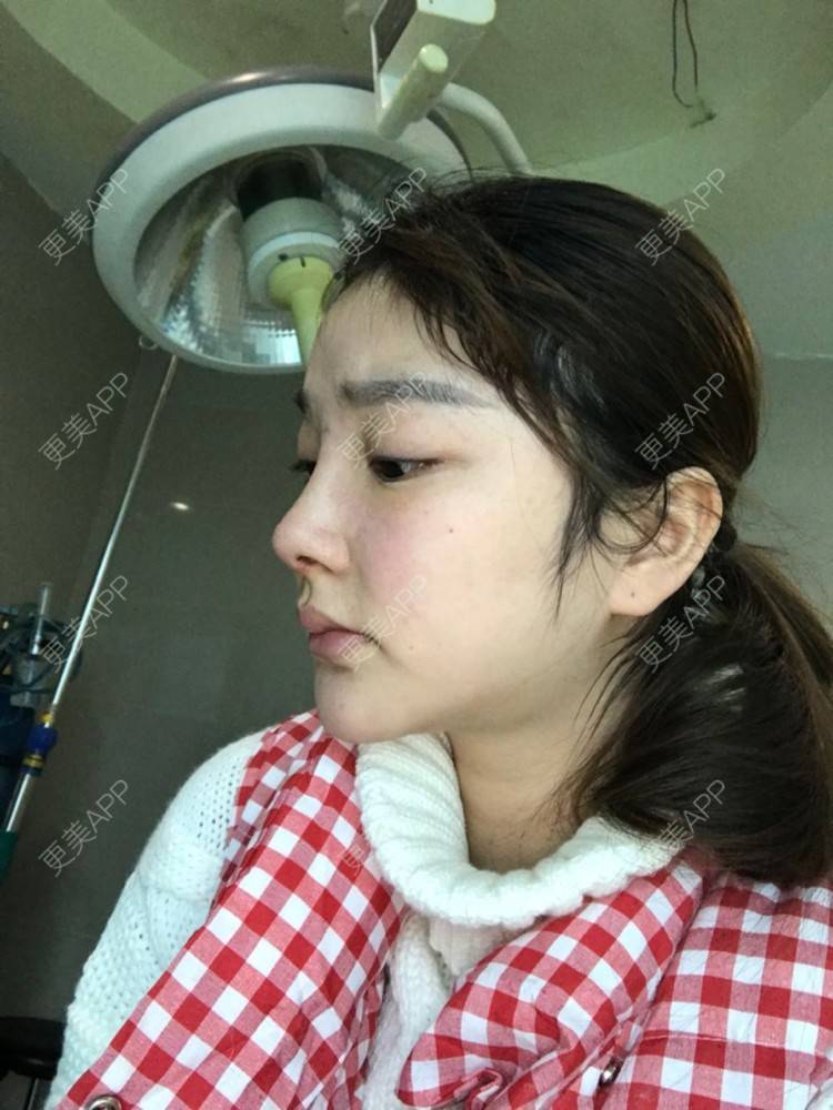 更美 - 雪儿妹子的肋软骨隆鼻经验 | 鼻部整形 | 肋软骨隆鼻 | 隆鼻失败修复 | 重庆