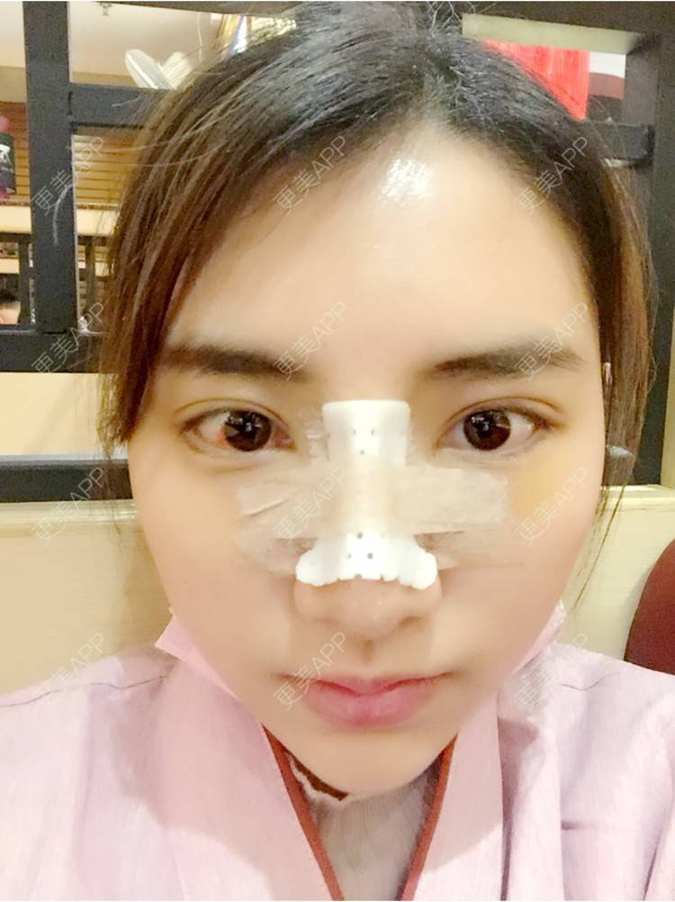 更美 - 黄金金的开外眼角经验 | 开外眼角 | 潮州 | 鼻骨内推 | 下至