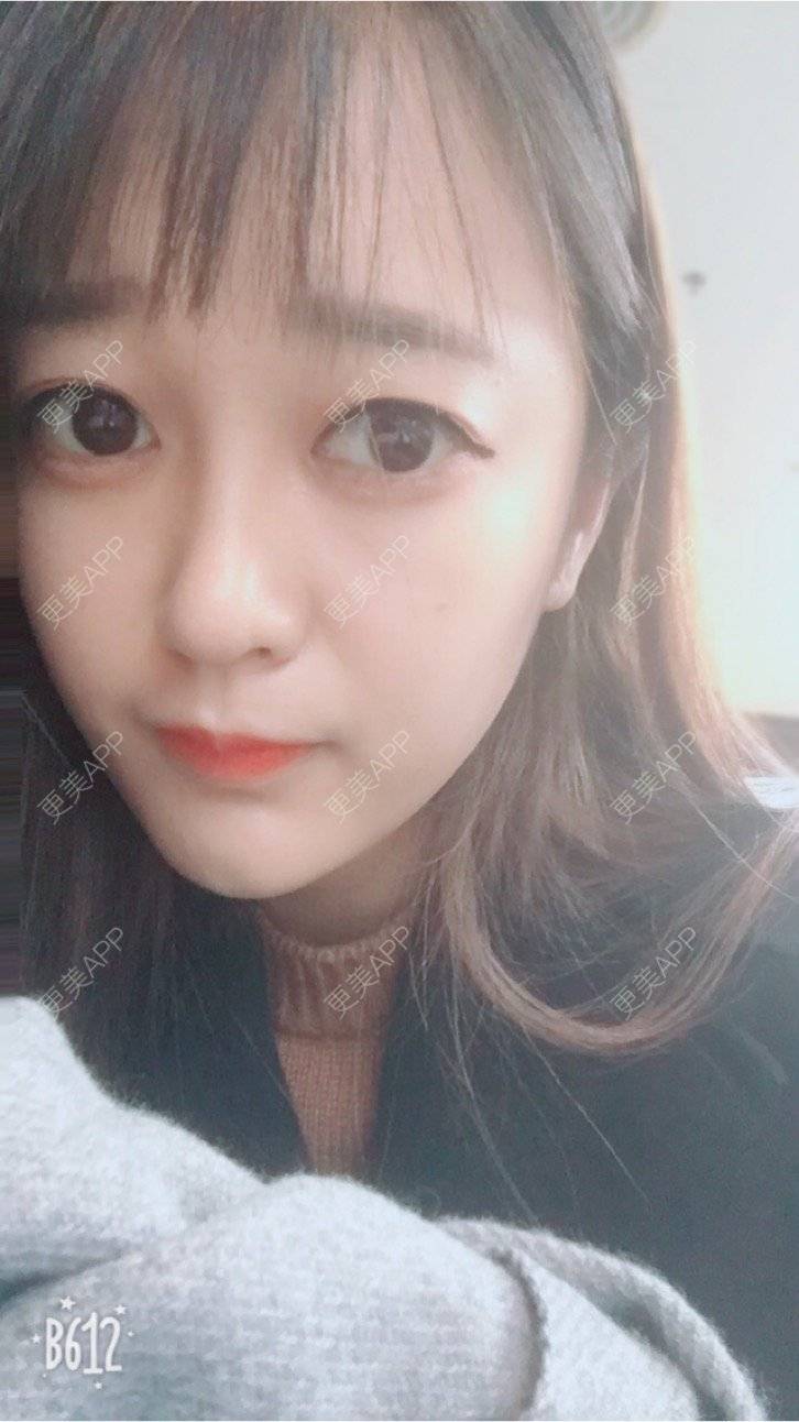 更美 - 匆匆1108的全脸整形套餐经验 | 全脸整形套餐 | 鼻部整形 | 武汉 | 隆鼻