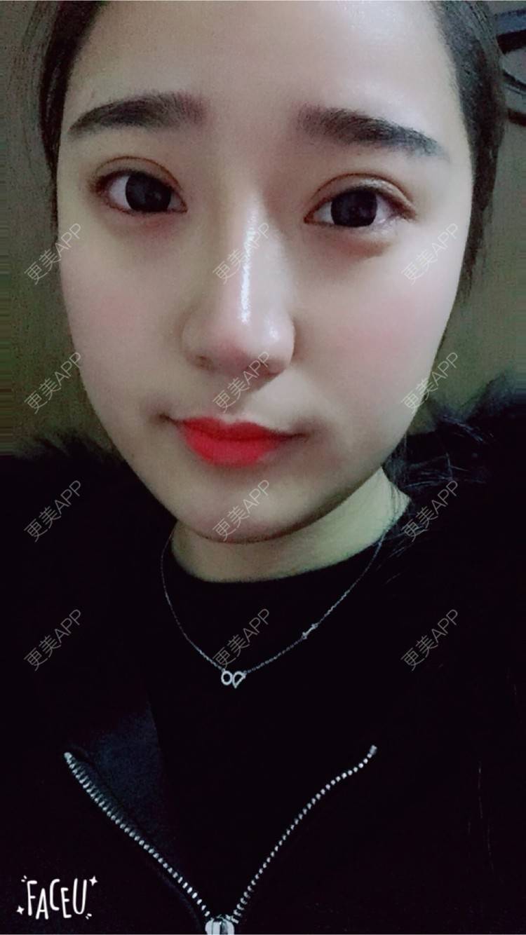 更美 - 邸红亮 医生的双眼皮经验 | 视频日记 | 双眼皮 | 膨体隆鼻加耳软骨延长鼻尖 | 杭州