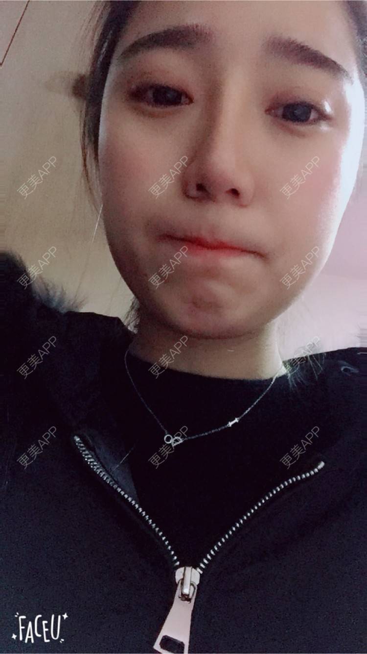 更美 - 邸红亮 医生的双眼皮经验 | 视频日记 | 双眼皮 | 膨体隆鼻加耳软骨延长鼻尖 | 杭州