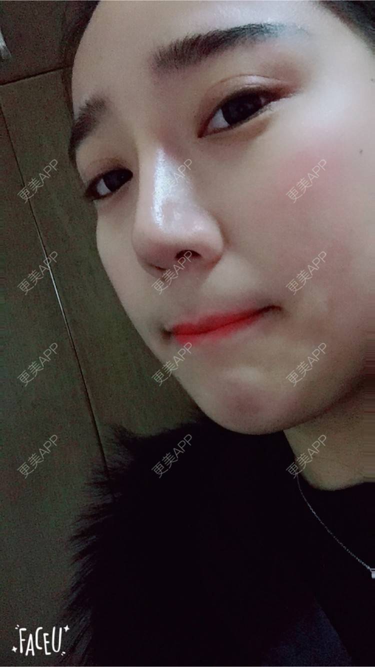 更美 - 邸红亮 医生的双眼皮经验 | 视频日记 | 双眼皮 | 膨体隆鼻加耳软骨延长鼻尖 | 杭州