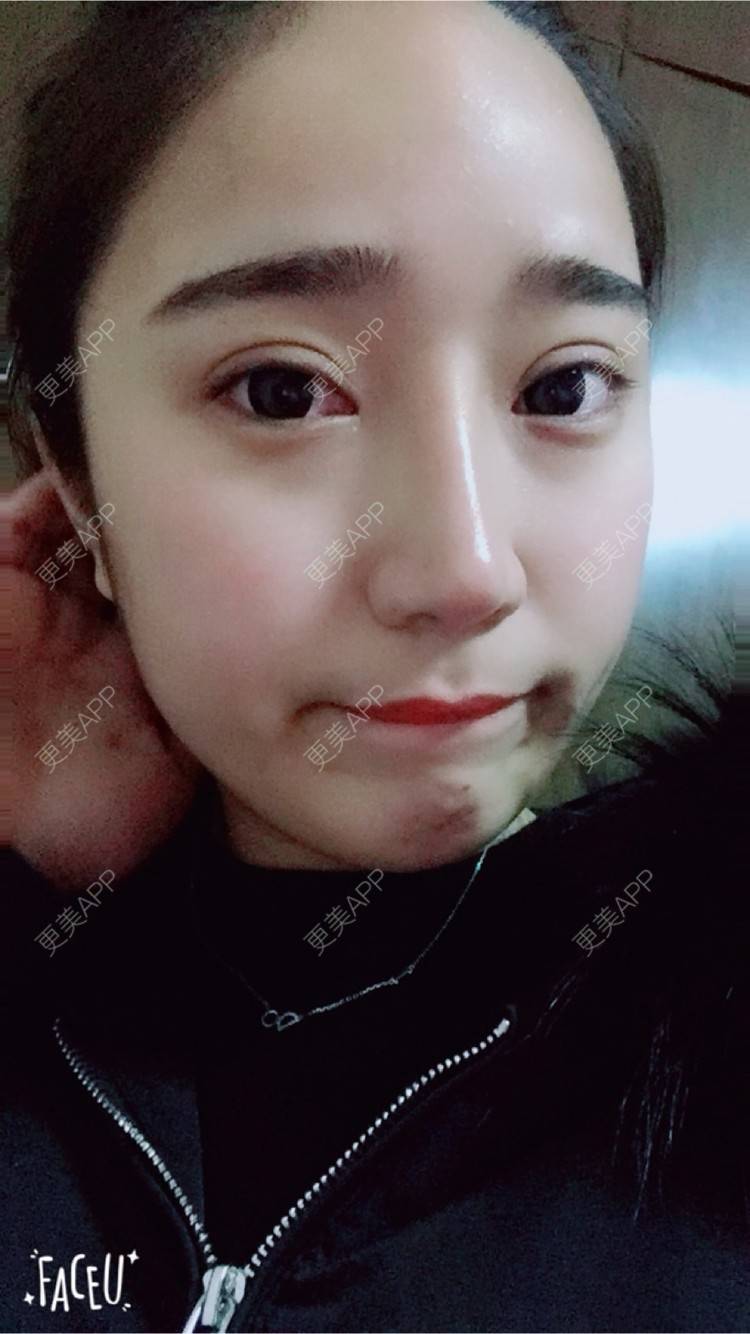 更美 - 邸红亮 医生的双眼皮经验 | 视频日记 | 双眼皮 | 膨体隆鼻加耳软骨延长鼻尖 | 杭州