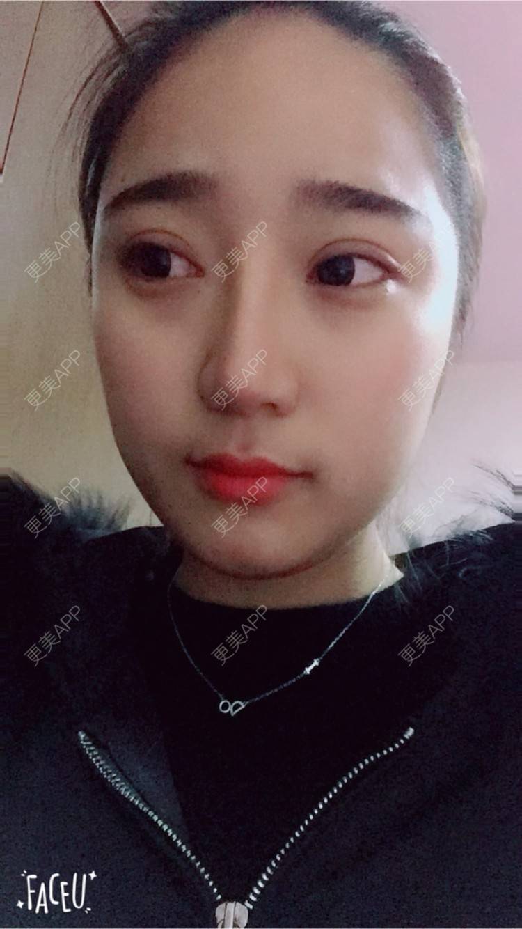 更美 - 邸红亮 医生的双眼皮经验 | 视频日记 | 双眼皮 | 膨体隆鼻加耳软骨延长鼻尖 | 杭州