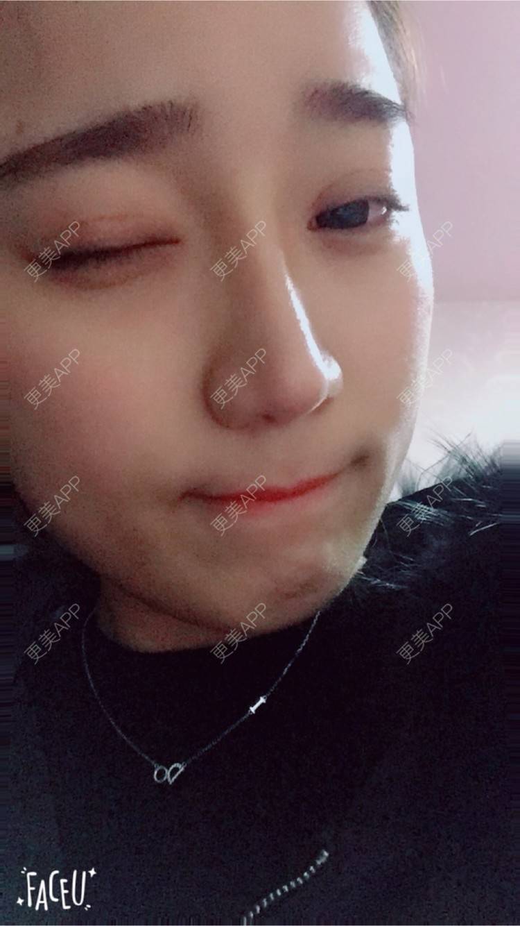 更美 - 邸红亮 医生的双眼皮经验 | 视频日记 | 双眼皮 | 膨体隆鼻加耳软骨延长鼻尖 | 杭州