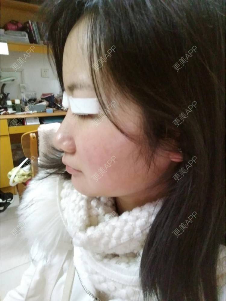 更美 - 谁叫我是水瓶座的全切双眼皮经验 | 眼部多项 | 精切双眼皮 | 全切双眼皮 | 武汉